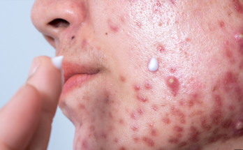 Treatments and Natural Remedies to Get Rid of Hormonal Acne