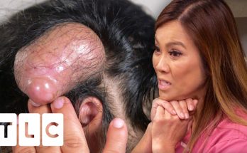 Dr Lee May Have Extracted The Biggest Pillar Cyst She Has Ever Seen! | Dr. Pimple Popper Pop Ups