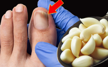 The Ultimate Nail Fungus Killer: A Natural Remedy That Works Fast