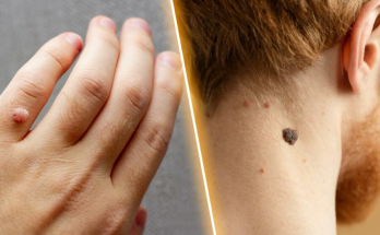 How to Safely and Effectively Remove Skin Tags and Warts Overnight