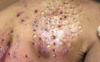 What can cause raised skin bumps?