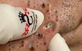 Whiteheads vs. Blackheads: Causes, Treatments, and Tips (Video)