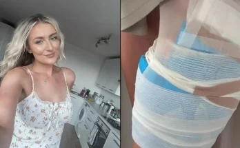 Woman 'burnt alive' after hot water bottle exploded onto her bare skin gives stark warning over using them in winter