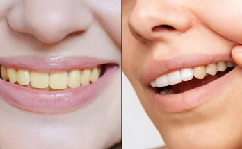 Dentist reveals common Christmas mistake people make that causes their teeth to turn yellow