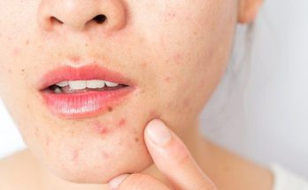 Adult Acne: I’m a Decade Past Puberty — Why Am I Still Breaking Out?