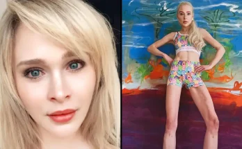 Woman Who Paid $161,000 To Extend Her Legs By 5.5 Inches Left With Huge Regrets