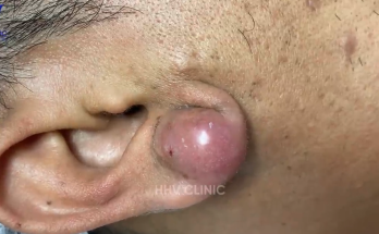 TREATMENT OF PIMPLES (ABSCESSES IN THE EAR AREA) IS COMMITTED TO NOT RECURRING, NOT LEAVING SCARS 