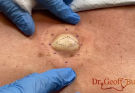 TREATMENT OF Epidermal Cyst on Back IS COMMITTED TO NOT RECURRING, NOT LEAVING SCARS