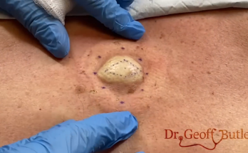 TREATMENT OF Epidermal Cyst on Back IS COMMITTED TO NOT RECURRING, NOT LEAVING SCARS