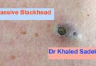 Summarize What is blackheads? How to remove, prevention and treatment