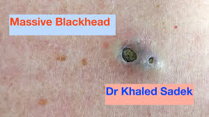 Summarize What is blackheads? How to remove, prevention and treatment