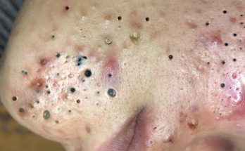 Blackhead Removal Results You Need to See!