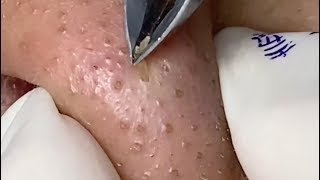 How to Remove and Get Rid of Giant Blackheads