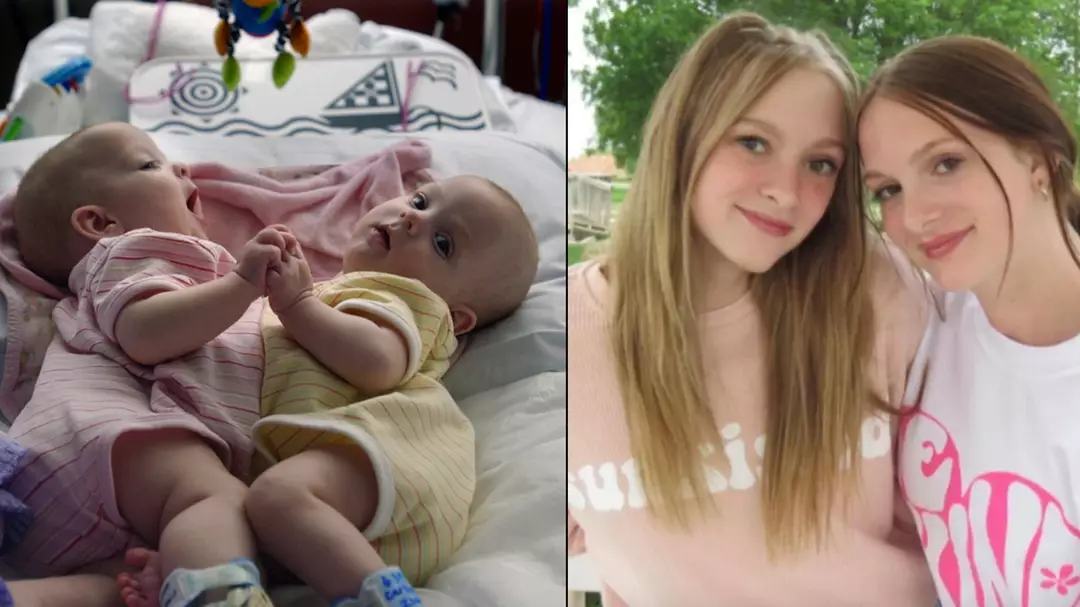 Conjoined twins who were separated as babies shared update on their lives 10 years later