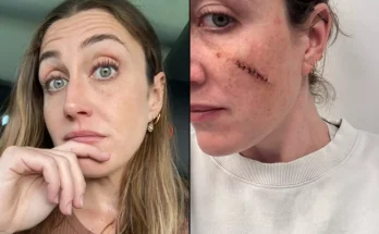 Woman who thought blemish on face was just a spot issues warning after left needing 30 stitches