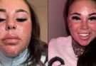 Influencer left horrified after accidentally burning skin off face while attempting ‘dangerous’ sunbed hack