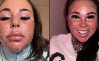 Influencer left horrified after accidentally burning skin off face while attempting ‘dangerous’ sunbed hack