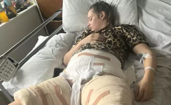 Student who suffered horrific burns after hot water bottle exploded warns others to ‘never’ use them