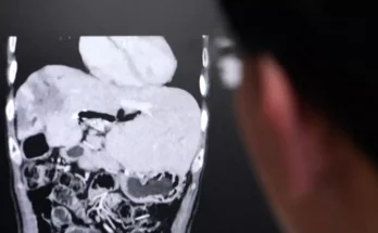 X-ray shows why single bite of popular Thai dish can give you liver cancer