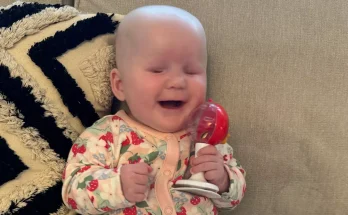 Twin baby girl born with incredibly rare condition that means she has no eyes