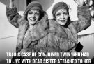 Tragic case of conjoined twin who had to live with dead sister attached to her