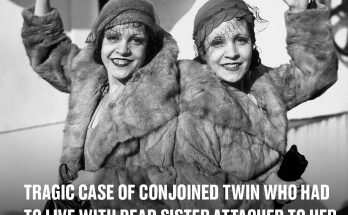 Tragic case of conjoined twin who had to live with dead sister attached to her