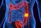 Experts find worrying link between colon cancer in young people and another health condition