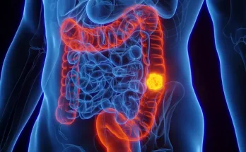 Experts find worrying link between colon cancer in young people and another health condition